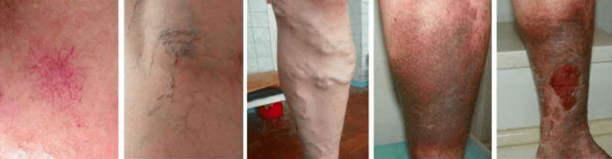 Stopnje varikoznih žil na nogah