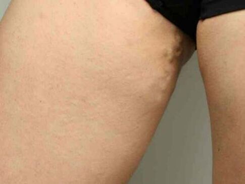 krčne žile medenice med nosečnostjo